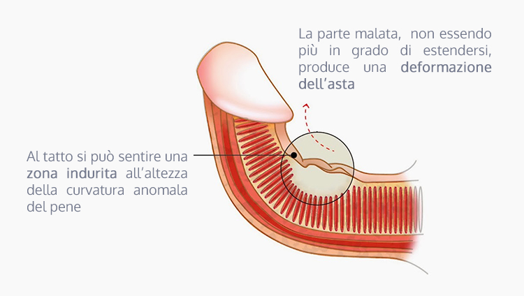 Induratio penis plastica (IPP) o malattia di La Peyronie (PD)